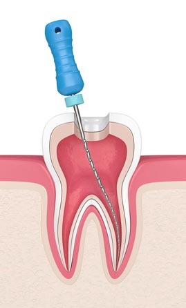 3D Illustration einer Endodontie-Behandlung