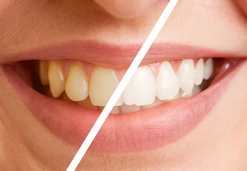 Ein Lächeln vor- und nach dem Bleaching