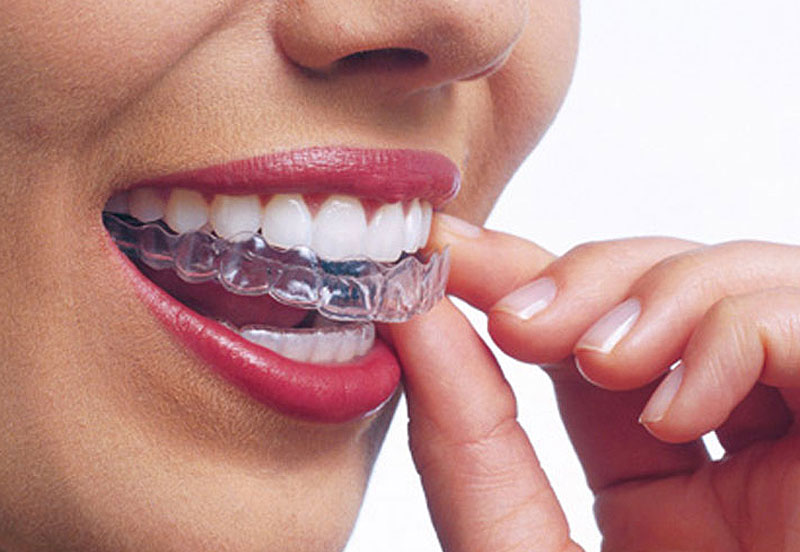 invisalign-berlin-kudamm1