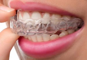 Michiganschiene bei Bruxismus