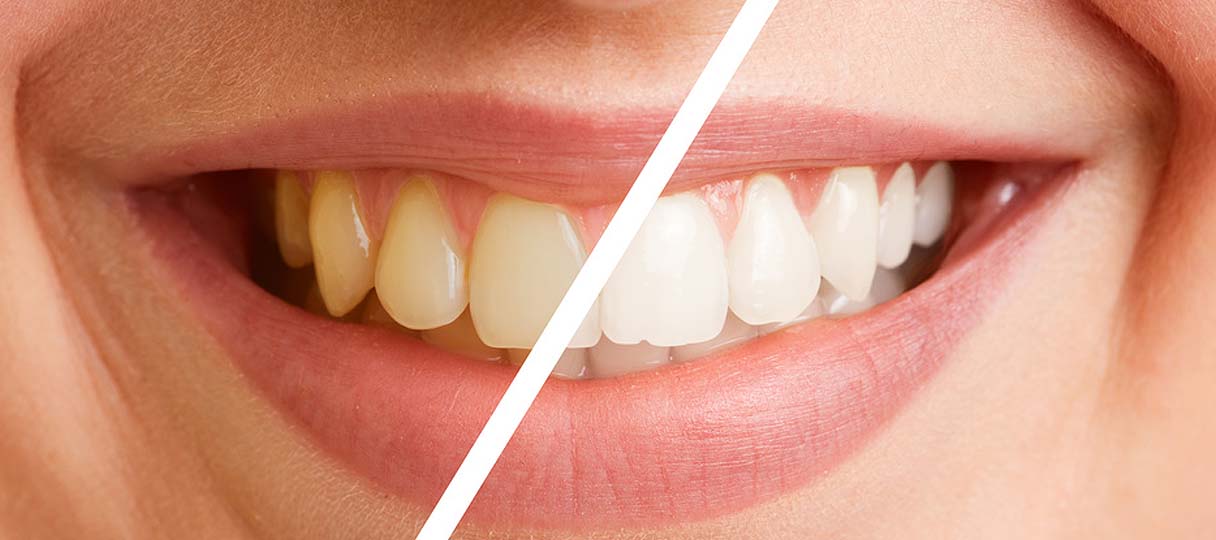 Bild: Querschnitt von Zähnen vor und nach dem Bleaching