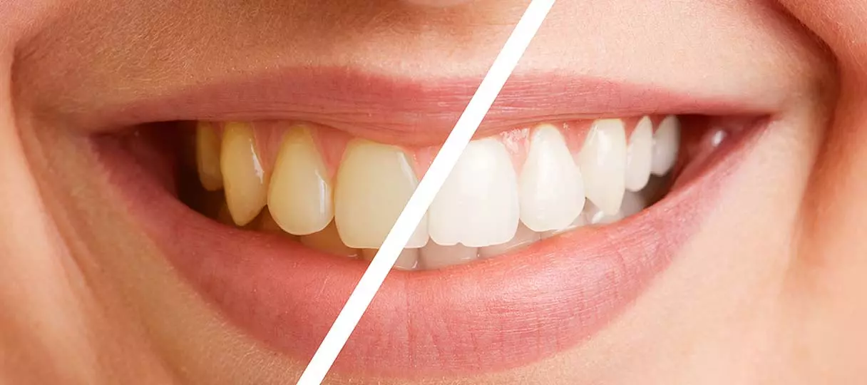 Bild: Querschnitt von Zähnen vor und nach dem Bleaching