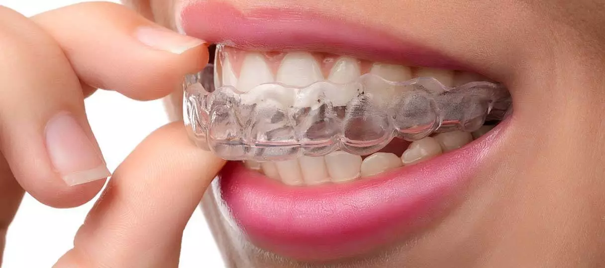 Bild bei der Entnahme eines Aligners von den Zähnen