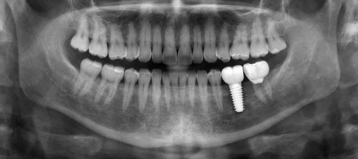 Röntgenbild eines Kiefers, mit Zahnimplantat und Krone