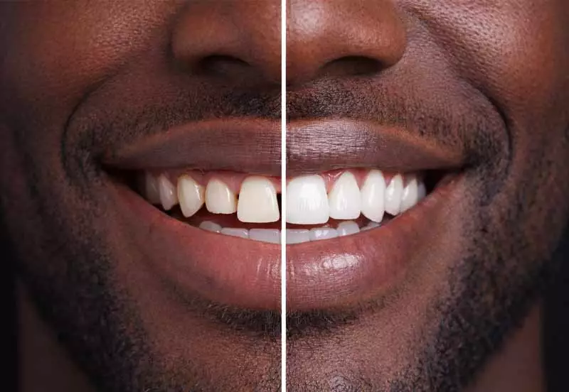 veneers-berlin-kudamm Vorher-/Nachher Aufnahme mit und ohne Veneers